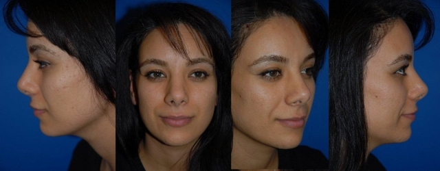 Operácia nosa - obľúbená u žien a dievčat fotky po rhinoplastike-štyri tváre