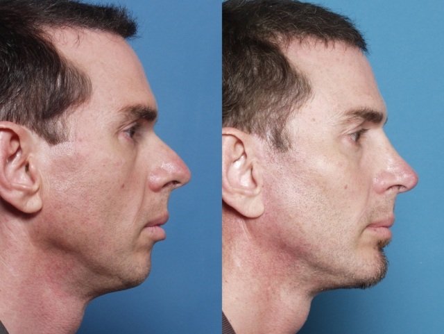 Niekedy to s rinoplastom skúšajú aj muži Operácia nosa chirurgom nosa
