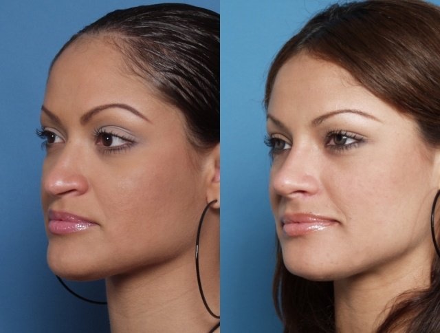 Celá krása žien nezávisí iba od nosa profilová žena rhinoplastika krása tvár