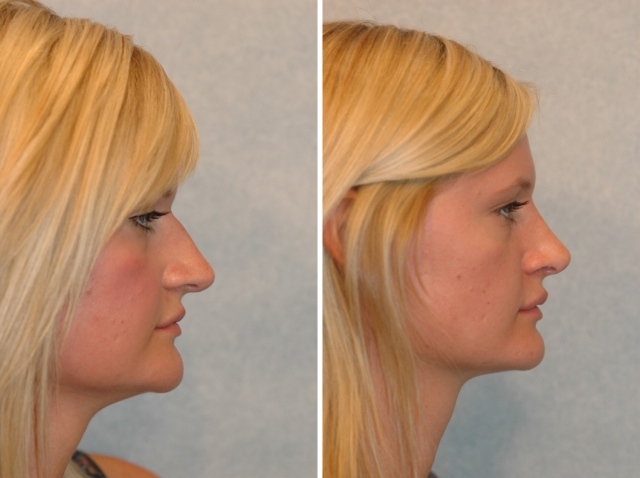 Po operácii nosa nezostali žiadne jazvy rinoplastika-chirurgia-profil-zeny-op