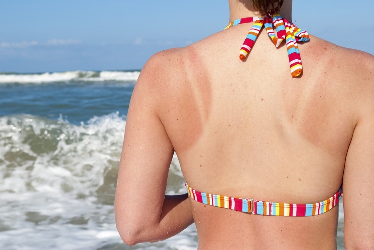 aplikácia aloe vera na pokožku spálenie od slnka