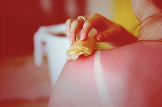 Masáž jablčným octom po opaľovaní Pomoc pri opaľovaní-jablčný ocot