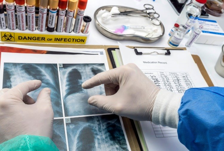 röntgenové lúče detských pľúc v dôsledku koronavírusu v štúdii detí