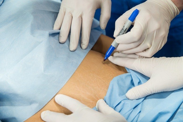 Odstránenie strií náklady na ošetrenie pokožky laserom