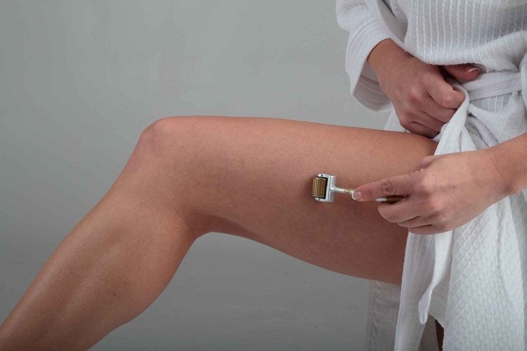 dermaroller aplikácia proti účinku celulitídy na stehná