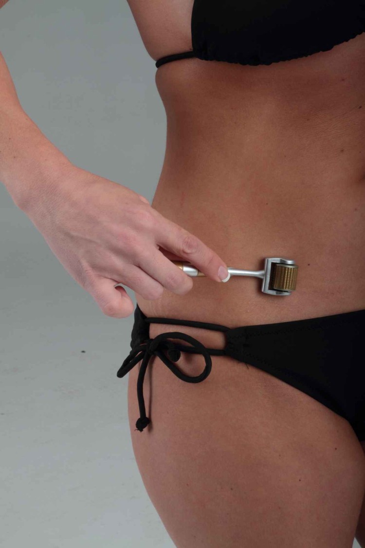 aplikácia dermarollera celotelové strie tehotenstvo