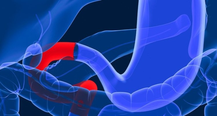 operácia mužského bypassu terapiou diabetes mellitus 2. typu bez potreby inzulínu