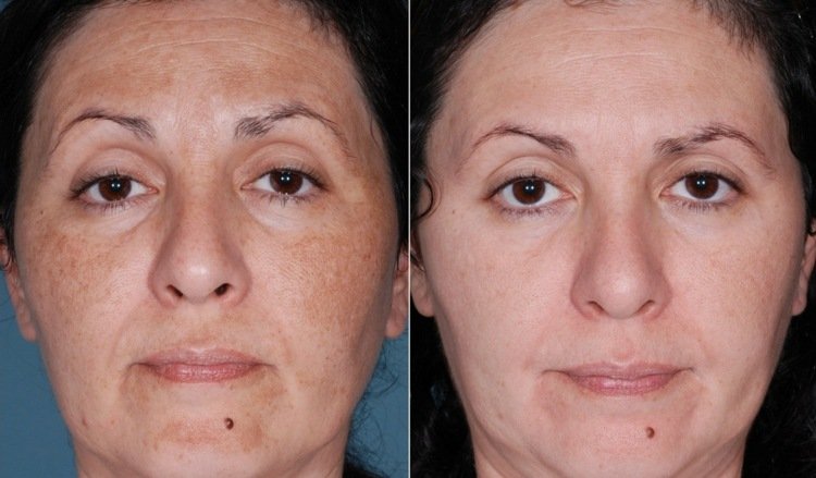 Zbavte sa veku a pigmentových škvŕn peelingom ovocnej kyseliny peeling ovocných kyselín-urob si sám-pred-po starnutí škvrny-pigmentové škvrny