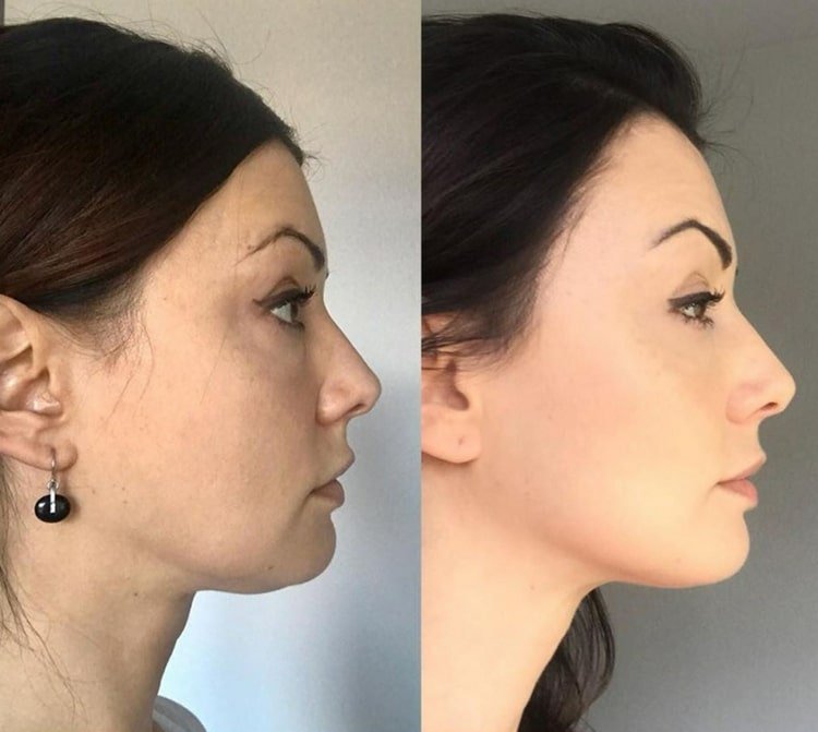 Udržujte bradu a líca pevnejšie pravidelným cvičením jogy