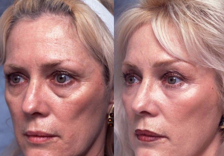 Jóga na tvár napína pokožku a vytvára mladistvý vzhľad