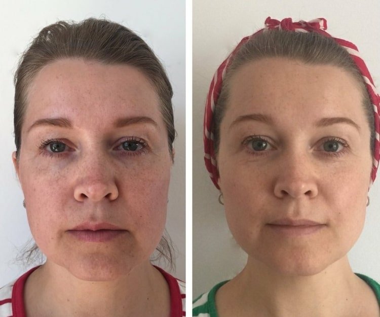 Zlepšite pleť vďaka lepšiemu prekrveniu prostredníctvom tvárových cvičení s jogou