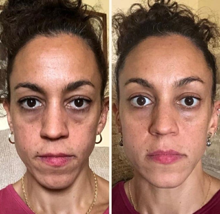 Vrecká pod očami pred a po pravidelnej joge na tvár