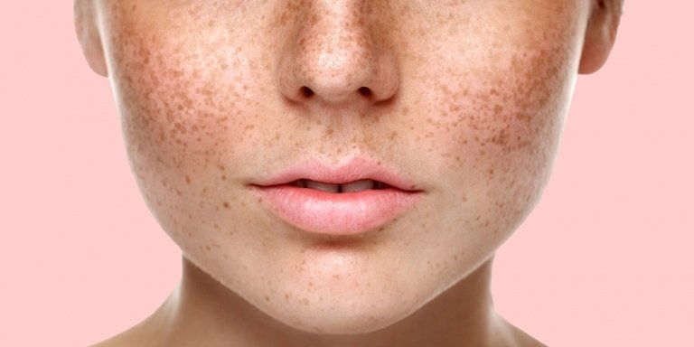 Keltská pokožka typu 1 veľa pih a svetlej pokožky