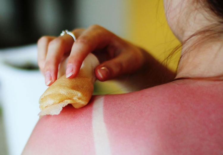 Med ako liek na spálenie pokožky od slnka