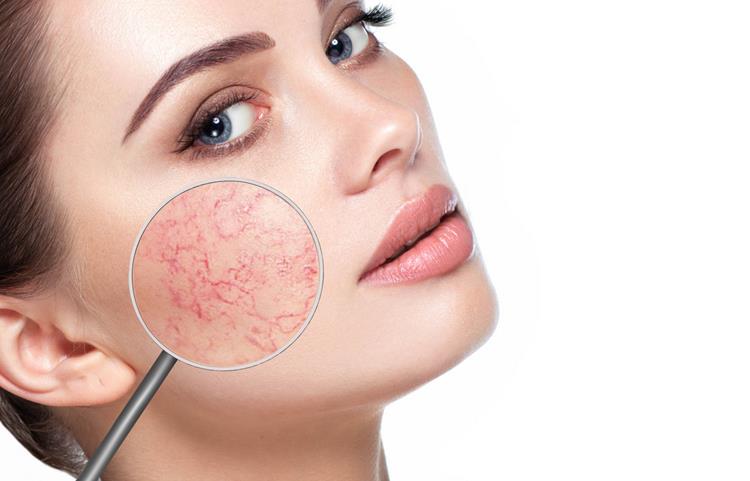 Rosacea sa prejavuje ako pustuly, uzlíky a viditeľné žilky