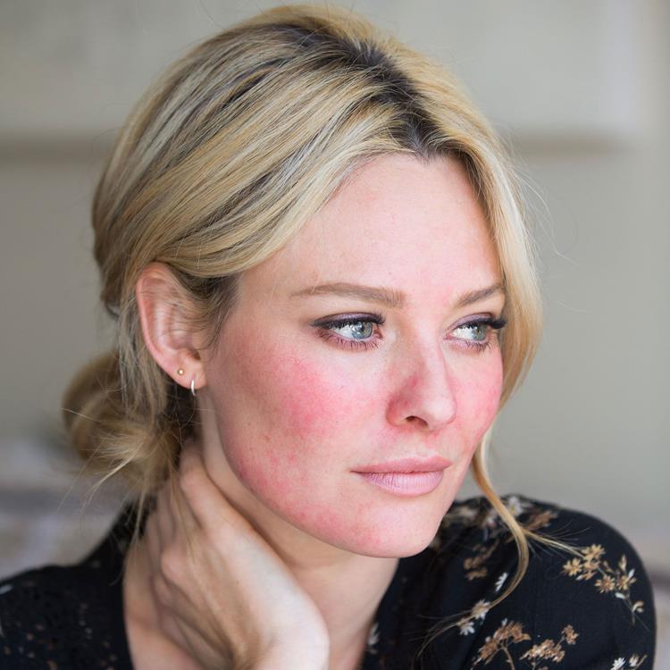 Rosacea môže byť bodavá, svrbivá, suchá a šupinatá