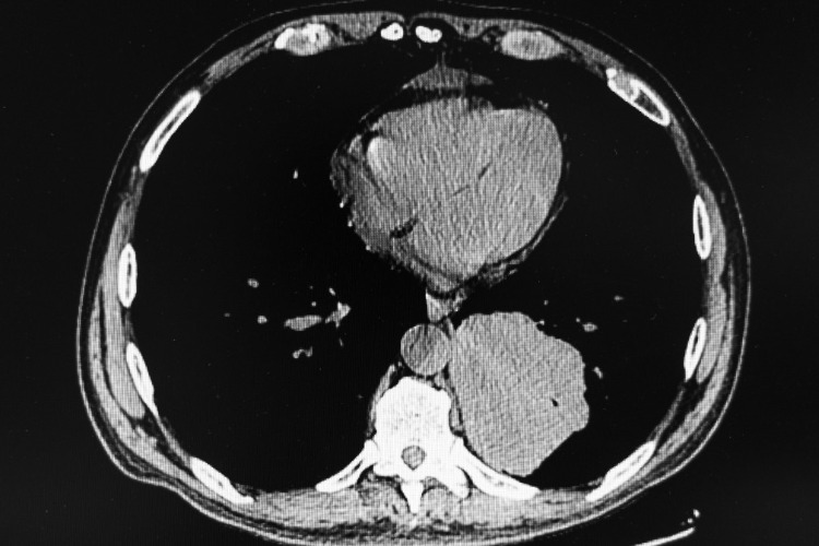 počítačová tomografia ukazuje pokročilý skvamocelulárny karcinóm v pľúcach