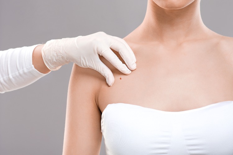 dermatológ vidí materské znamienko ženy ako riziko pre ľudské papilomavírusy