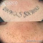 إزالة وشم الصورة 21.11.2018 №001 - إزالة الوشم بالصور -