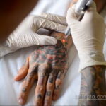 Fotoeksempel på fjernelse af en tatovering 31.05.2020 №1014 - tatovering-