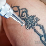 Fotoeksempel på fjernelse af en tatovering 31.05.2020 №1013 - tatovering-
