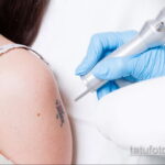 Fotoeksempel på fjernelse af en tatovering 31.05.2020 №1011 - tatovering-