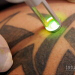 Fotoeksempel på fjernelse af en tatovering 31.05.2020 №1009 - tatovering-