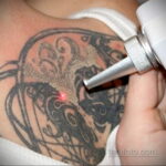 Fotoeksempel på fjernelse af en tatovering 31.05.2020 №1008 - tatovering-