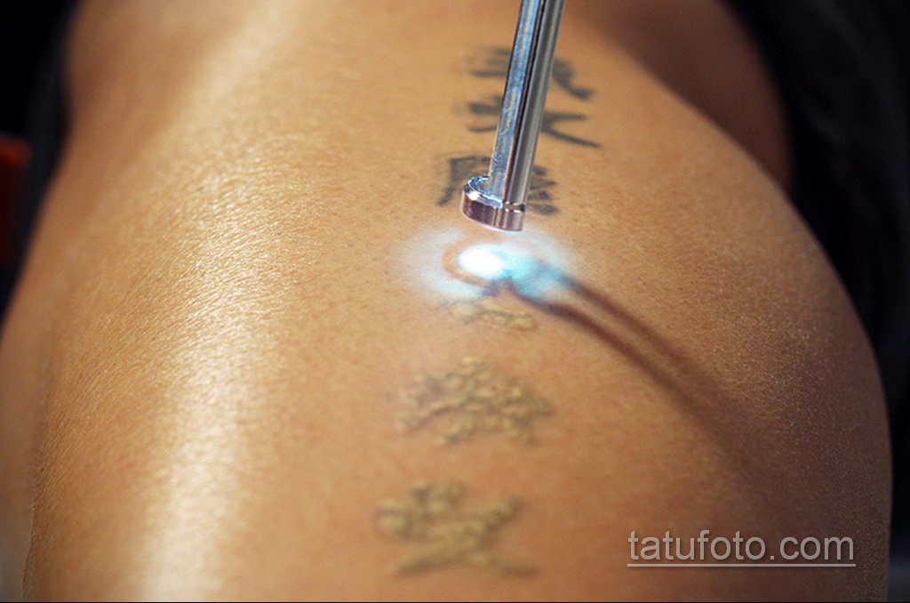 Fotoeksempel på fjernelse af en tatovering 31.05.2020 №1004 - tatovering-