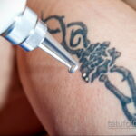 Fotoeksempel på fjernelse af en tatovering 31.05.2020 №1007 - tatovering-