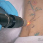 Fotoeksempel på fjernelse af en tatovering 31.05.2020 №1006 - tatovering-