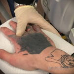 Fotoeksempel på fjernelse af en tatovering 31.05.2020 №1005 - tatovering-