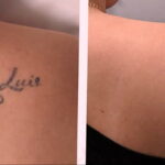 كيفية إزالة الوشم في الصالون والمنزل - 10022021 صورة - كيفية إزالة الوشم في الصالون والمنزل - 10022021 صورة - 2