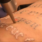 كيفية إزالة الوشم في الصالون والمنزل - 10022021 صورة - 18