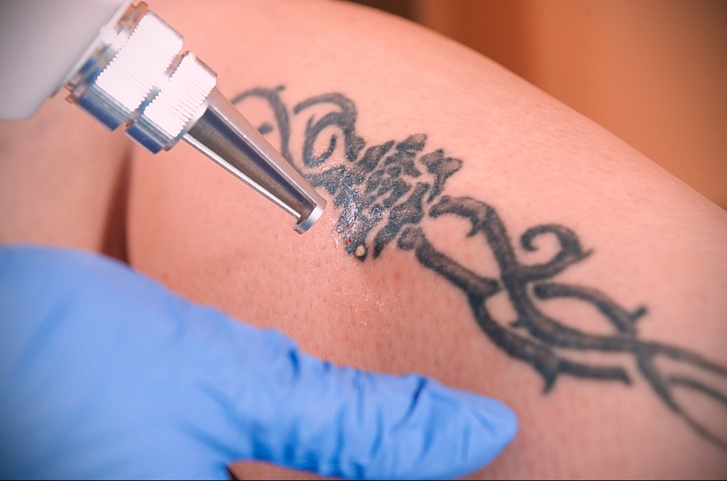 كيفية إزالة الوشم في الصالون والمنزل - 10022021 صورة - 3