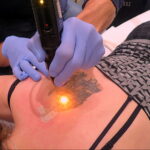 كيفية إزالة الوشم في الصالون والمنزل - 10022021 صورة - 16