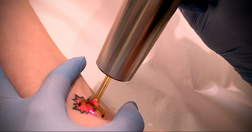 كيفية إزالة الوشم في الصالون والمنزل - 10022021 صورة - 6