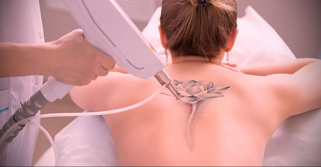 كيفية إزالة الوشم في الصالون والمنزل - 10022021 صورة - 8