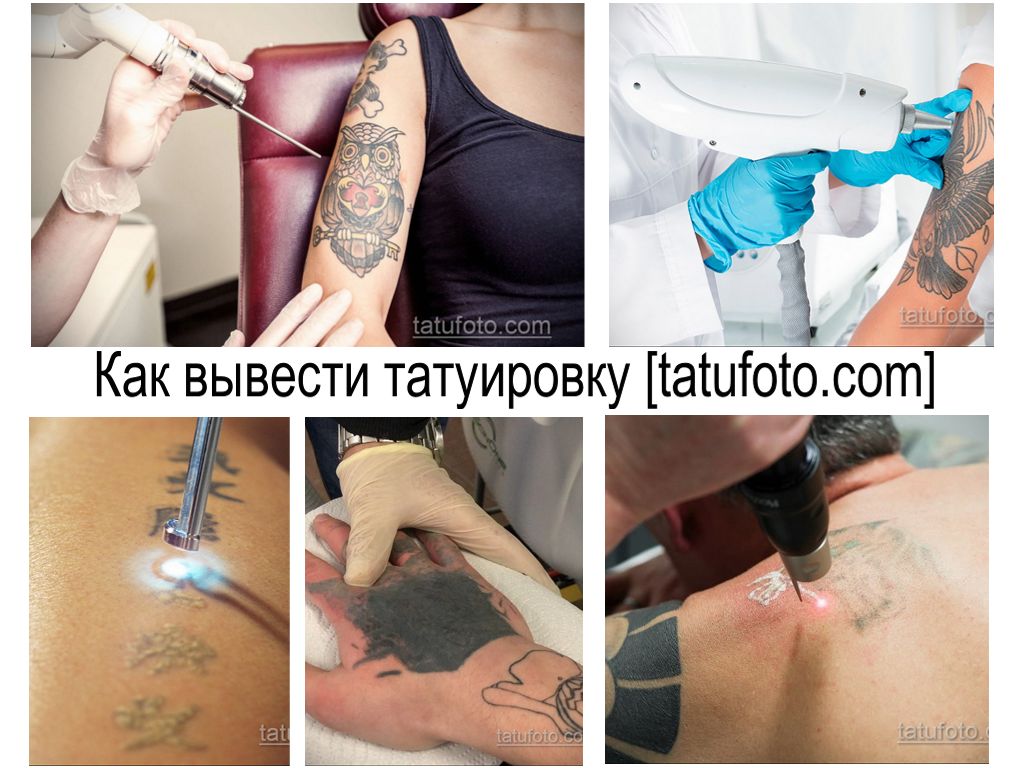 Sådan fjernes en tatovering - oplysninger om metoder til fjernelse af tatoveringer og fotoeksempler