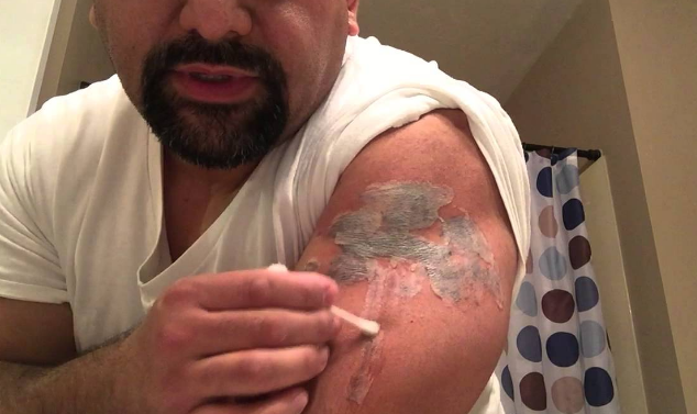 vegyi tetoválás eltávolítása - 25012021 - 5. fotó