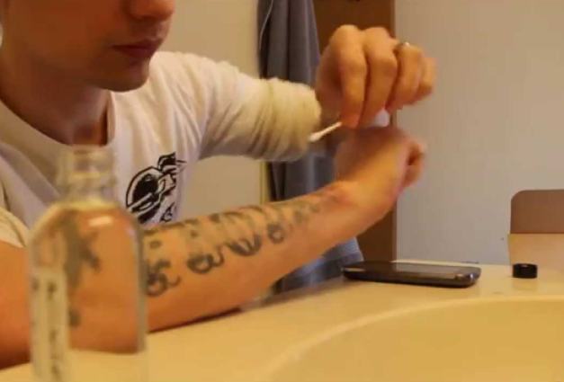 vegyi tetoválás eltávolítása - 25012021 - 6. fotó