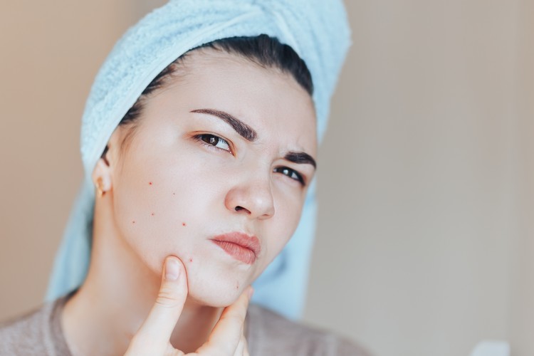 odstráňte masku na tvár s čiernymi bodkami pre pupienky