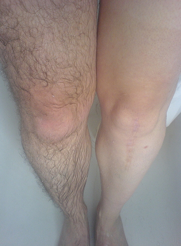 يمكنك عمل إزالة الشعر بالليزر على الوشم - صورة للمقال 20062021 4