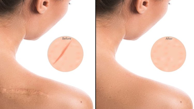 Pooperačná starostlivosť o jazvu podporuje hojenie po zatiahnutí stehov