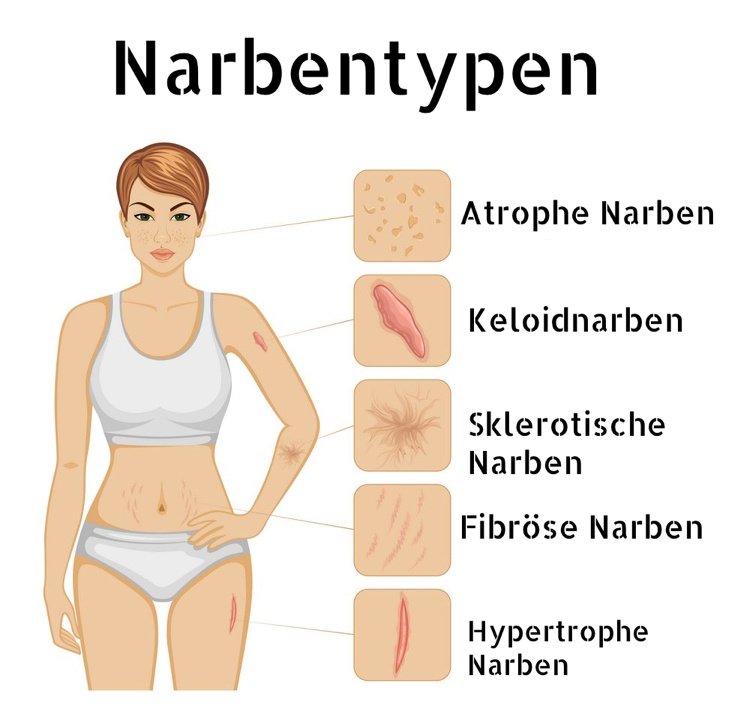 Starostlivosť o jazvu podľa chirurgického zákroku Typy jaziev na prvý pohľad Náčrt