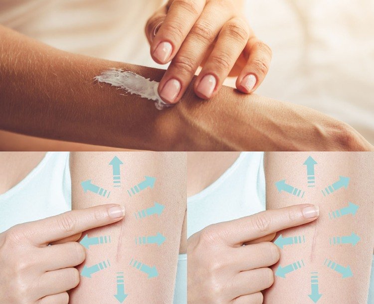 Po chirurgickom zákroku urobte jazvy neviditeľnými pomocou hojivých masti