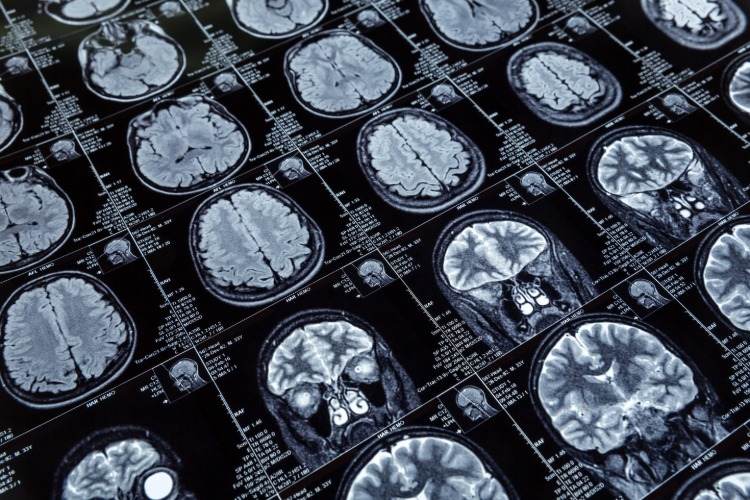 počítačová tomografia mozgu v prípade demencie alebo Alzheimerovej choroby