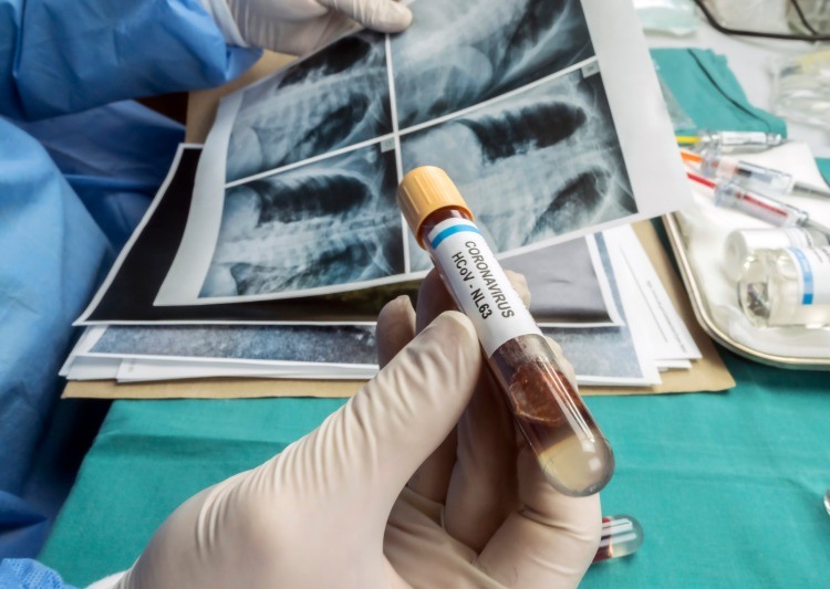 vedec analyzuje vzorky krvi od infikovaných pacientov covid 19 a röntgenové lúče
