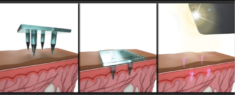 Невидими технологични татуировки за идентификация и регистрация на хора със и без ваксинации - снимка