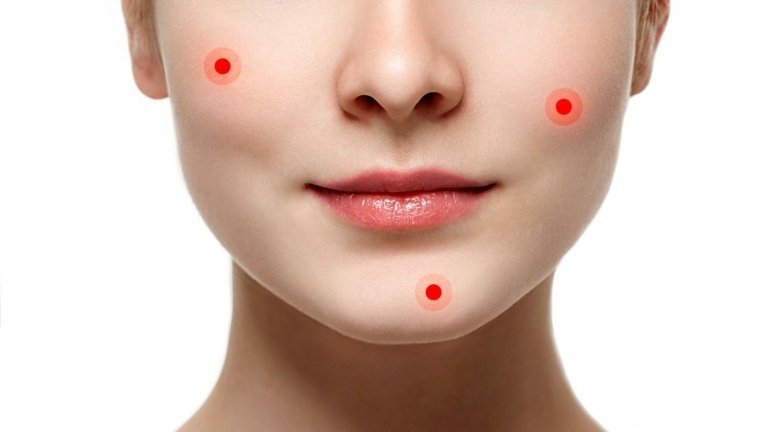 Pupienky pod kožou - čo sa s nimi dá robiť a ako im predchádzať